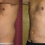 Male Liposuction Abdomen Before & After Patient #5629