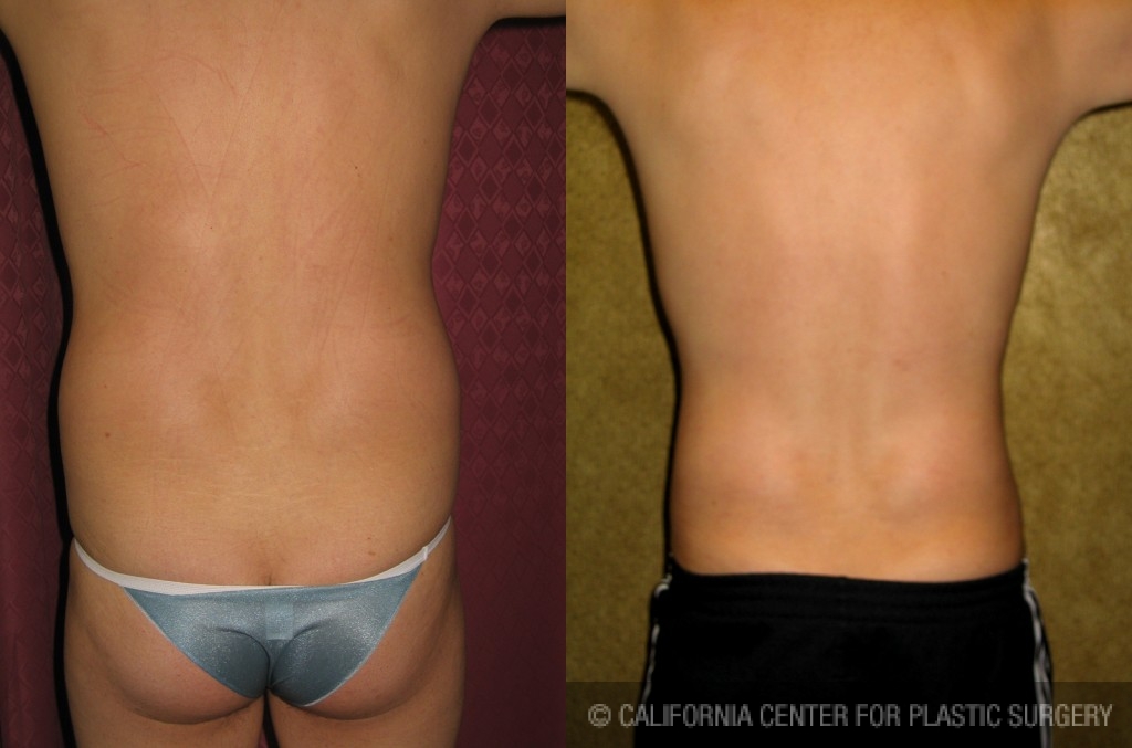 Male Liposuction Abdomen Before & After Patient #5629