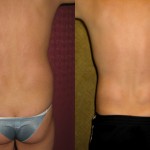 Male Liposuction Abdomen Before & After Patient #5629