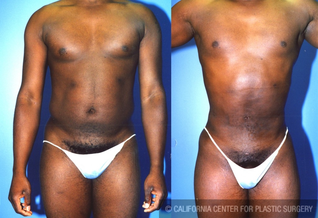 Male Liposuction Abdomen Before & After Patient #5638