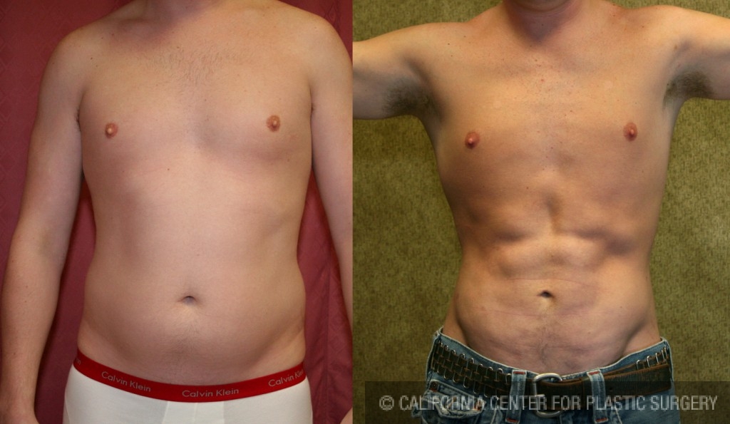 Male Liposuction Abdomen Before & After Patient #5600