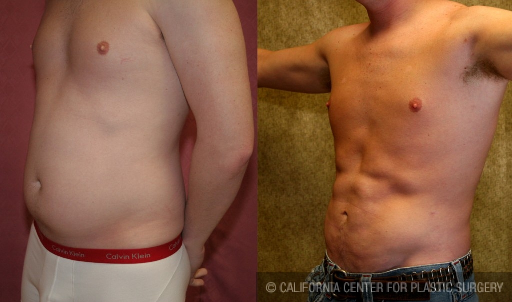 Male Liposuction Abdomen Before & After Patient #5600