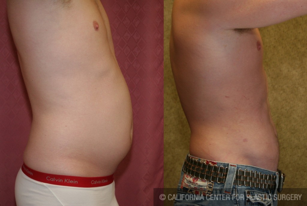 Male Liposuction Abdomen Before & After Patient #5600