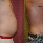 Male Liposuction Abdomen Before & After Patient #5600