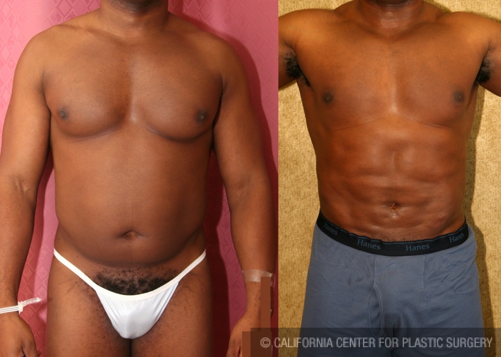 Male Liposuction Abdomen Before & After Patient #5661