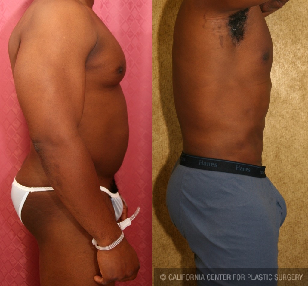 Male Liposuction Abdomen Before & After Patient #5661