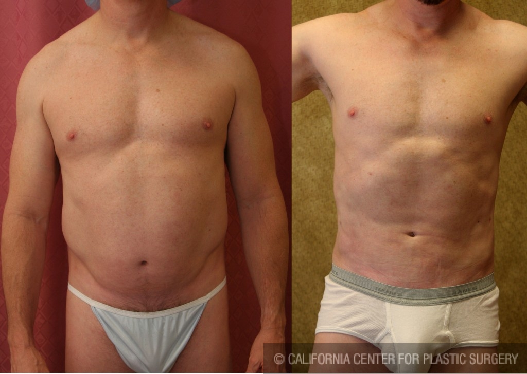 Male Liposuction Abdomen Before & After Patient #5670