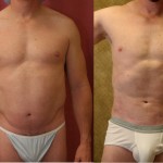 Male Liposuction Abdomen Before & After Patient #5670