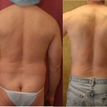 Male Liposuction Abdomen Before & After Patient #5670