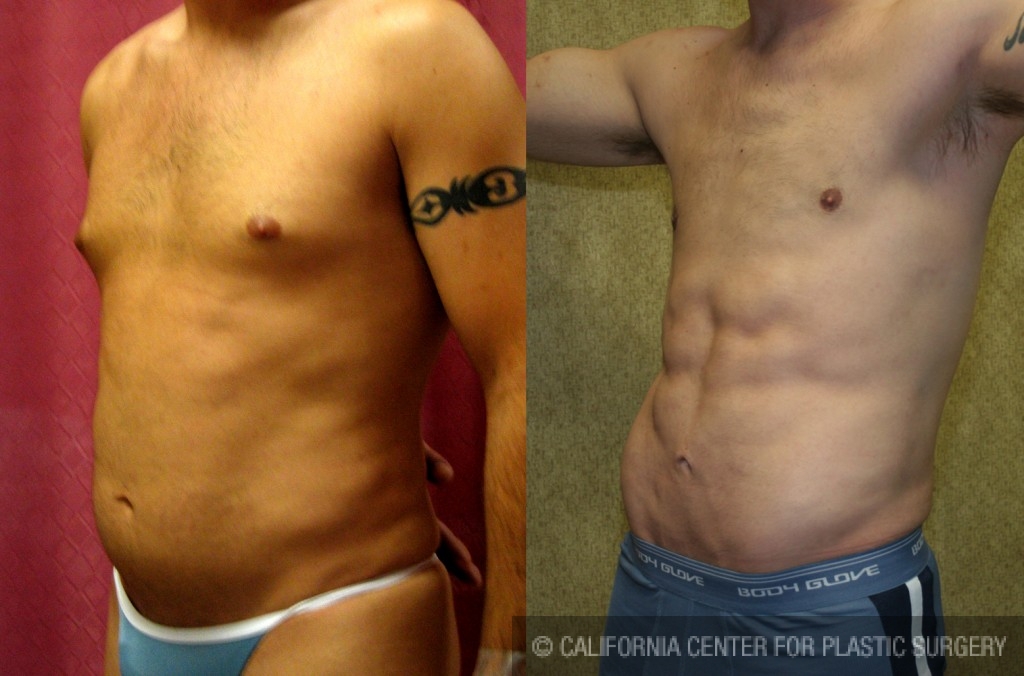 Liposuction - Male Chest Before and After Pictures Case 3