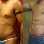 Male Liposuction Abdomen Before & After Patient #5604