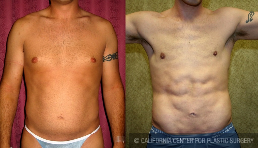 Male Liposuction Abdomen Before & After Patient #5604