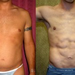 Male Liposuction Abdomen Before & After Patient #5604