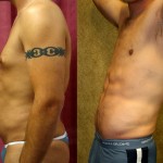 Male Liposuction Abdomen Before & After Patient #5604