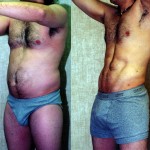 Male Liposuction Abdomen Before & After Patient #5609