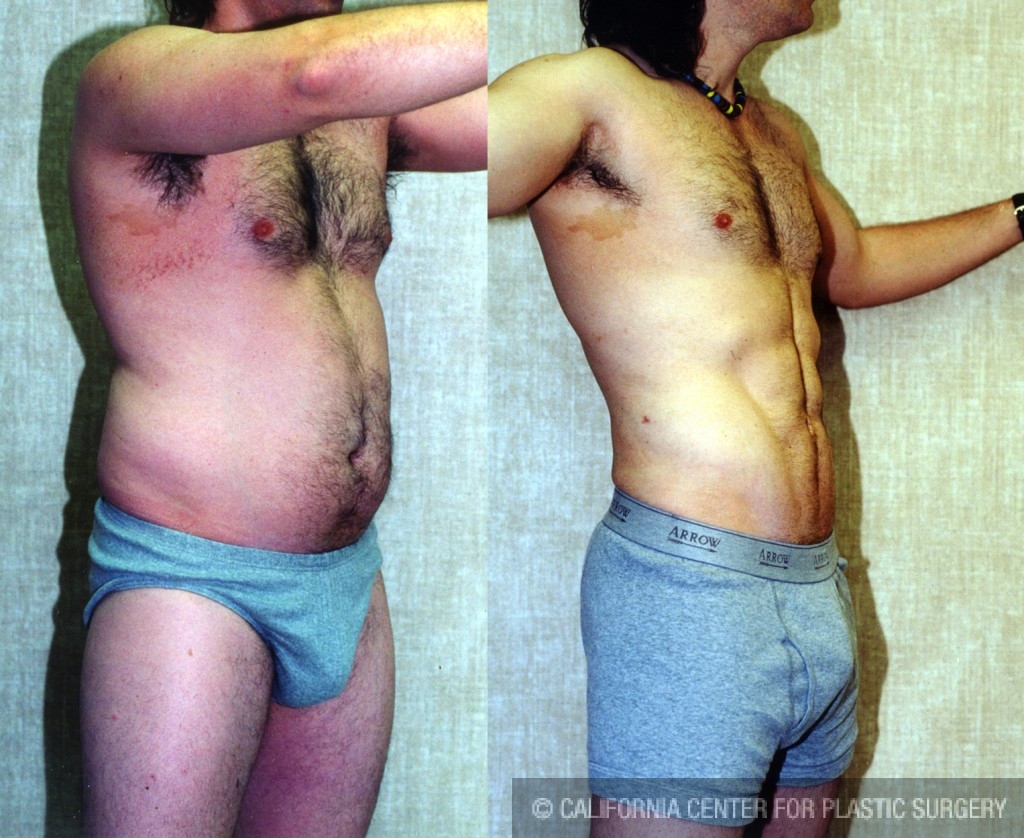 Male Liposuction Abdomen Before & After Patient #5609