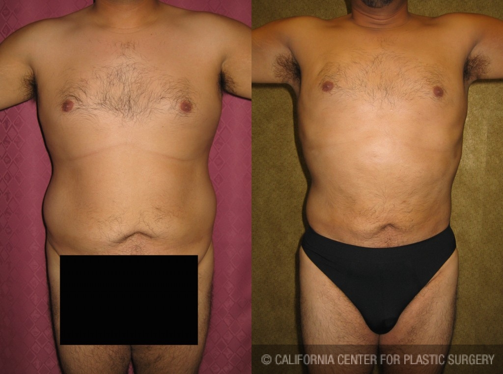 Male Liposuction Abdomen Before & After Patient #5622