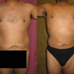 Male Liposuction Abdomen Before & After Patient #5622