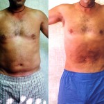 Male Liposuction Abdomen Before & After Patient #5625