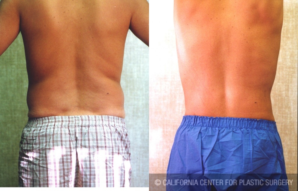 Male Liposuction Abdomen Before & After Patient #5625