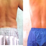 Male Liposuction Abdomen Before & After Patient #5625