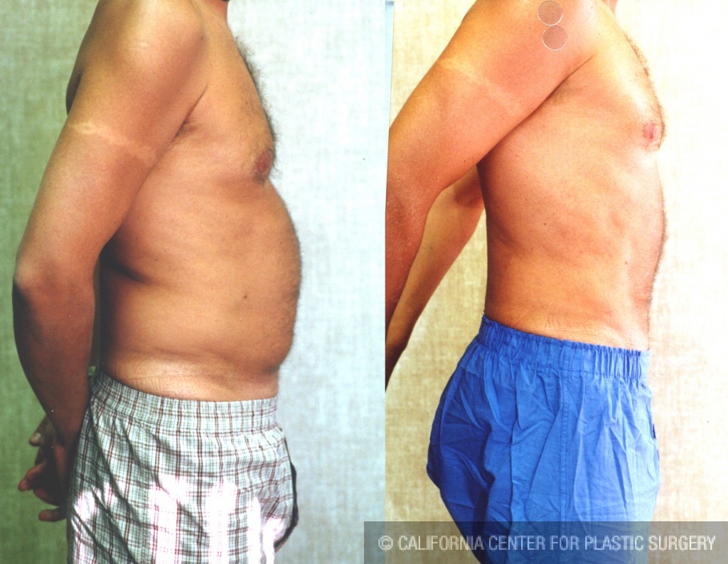 Liposuction for Men Before & After Photos Patient 149