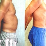 Male Liposuction Abdomen Before & After Patient #5625