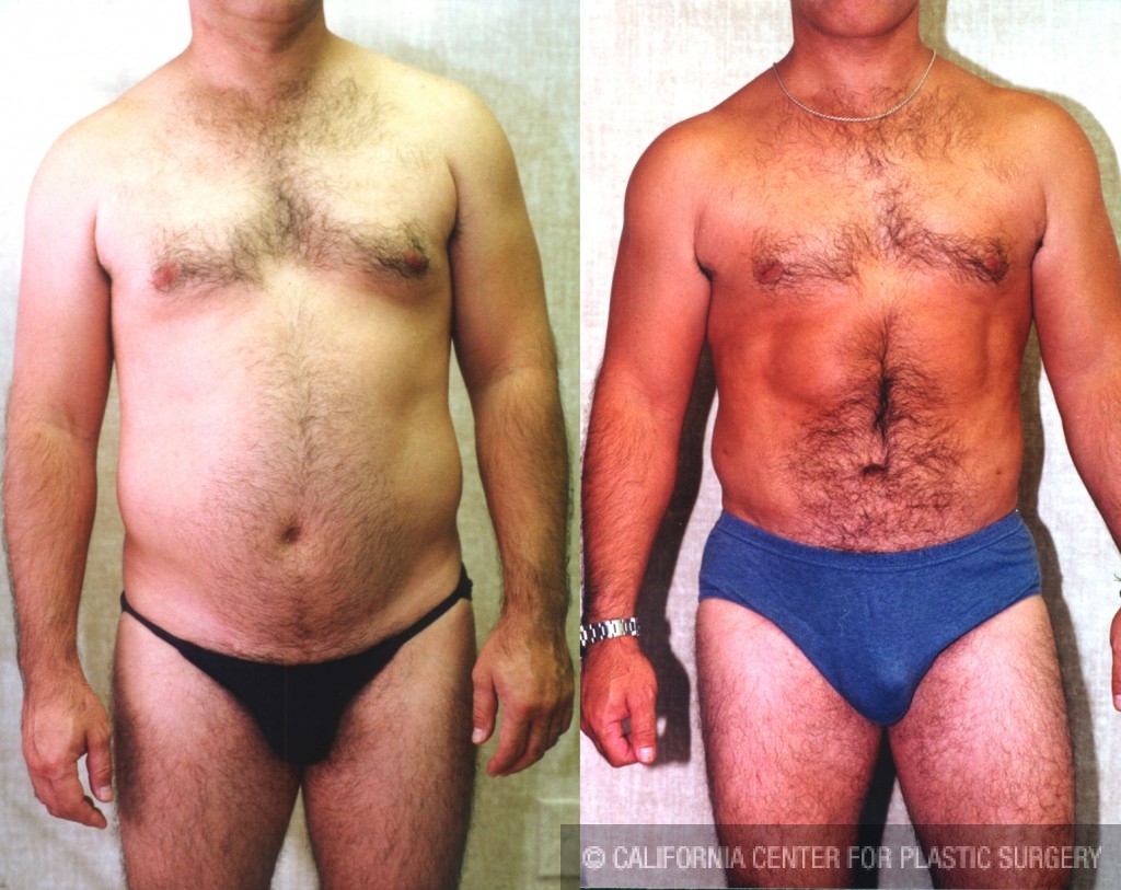 Abdominoplasty and Liposuction Thighs and Flanks Case 92109 - The Plastic  Surgery Group