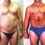 Male Liposuction Abdomen Before & After Patient #5633