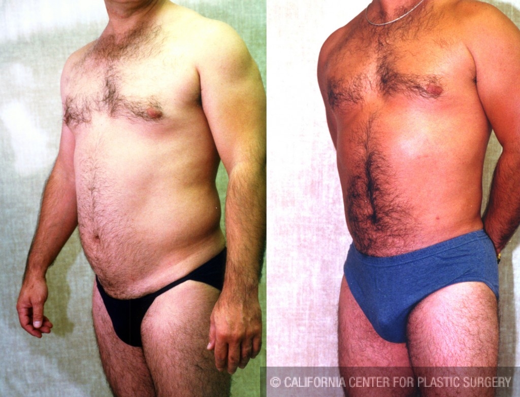 Male Liposuction Abdomen Before & After Patient #5633