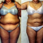 Liposuction Abdomen Plus Size Before & After Patient #5575