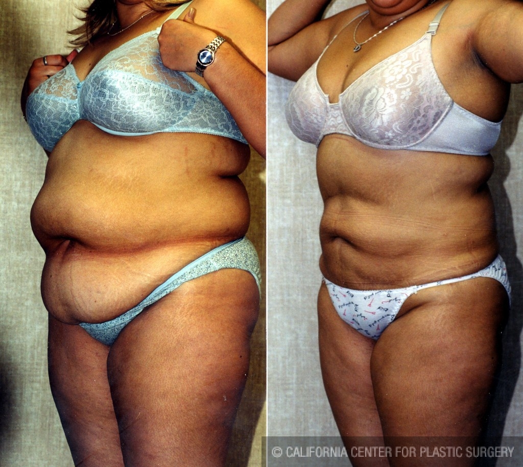 Liposuction Abdomen Plus Size Before & After Patient #5575