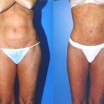 Liposuction Abdomen Medium Before & After Patient #5548