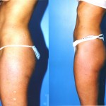 Liposuction Abdomen Medium Before & After Patient #5548