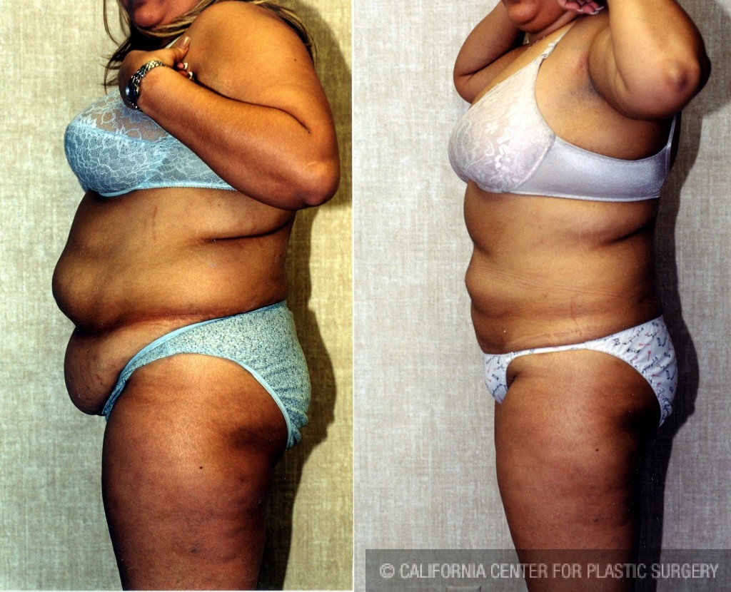 Liposuction Abdomen Plus Size Before & After Patient #5575