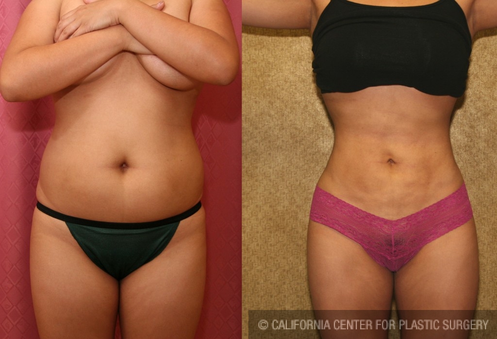 Liposuction Abdomen Medium Before & After Patient #5514