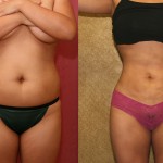 Liposuction Abdomen Medium Before & After Patient #5514