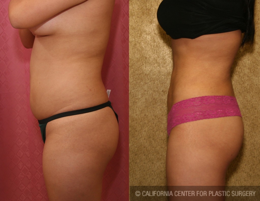 Liposuction Abdomen Medium Before & After Patient #5514