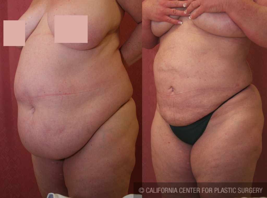 Liposuction Abdomen Plus Size Before & After Patient #5571