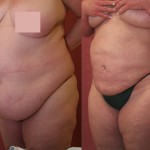 Liposuction Abdomen Plus Size Before & After Patient #5571