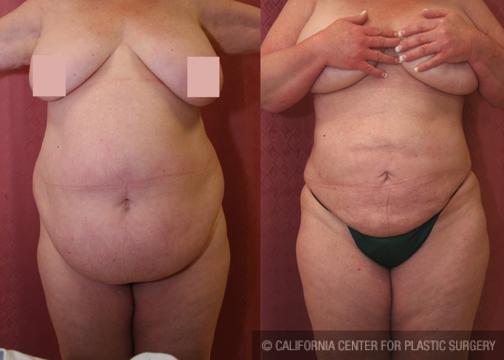 Liposuction Abdomen Plus Size Before & After Patient #5571