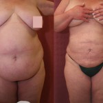 Liposuction Abdomen Plus Size Before & After Patient #5571
