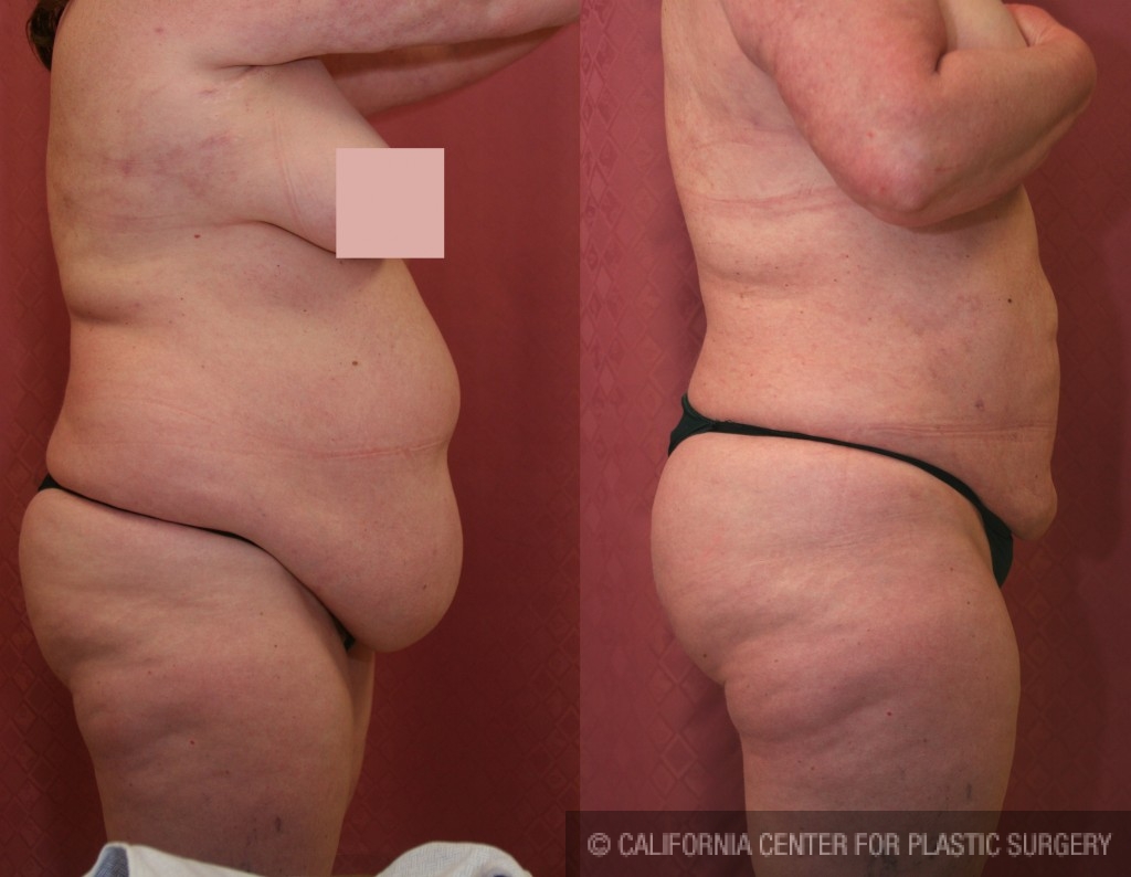 Liposuction Abdomen Plus Size Before & After Patient #5571