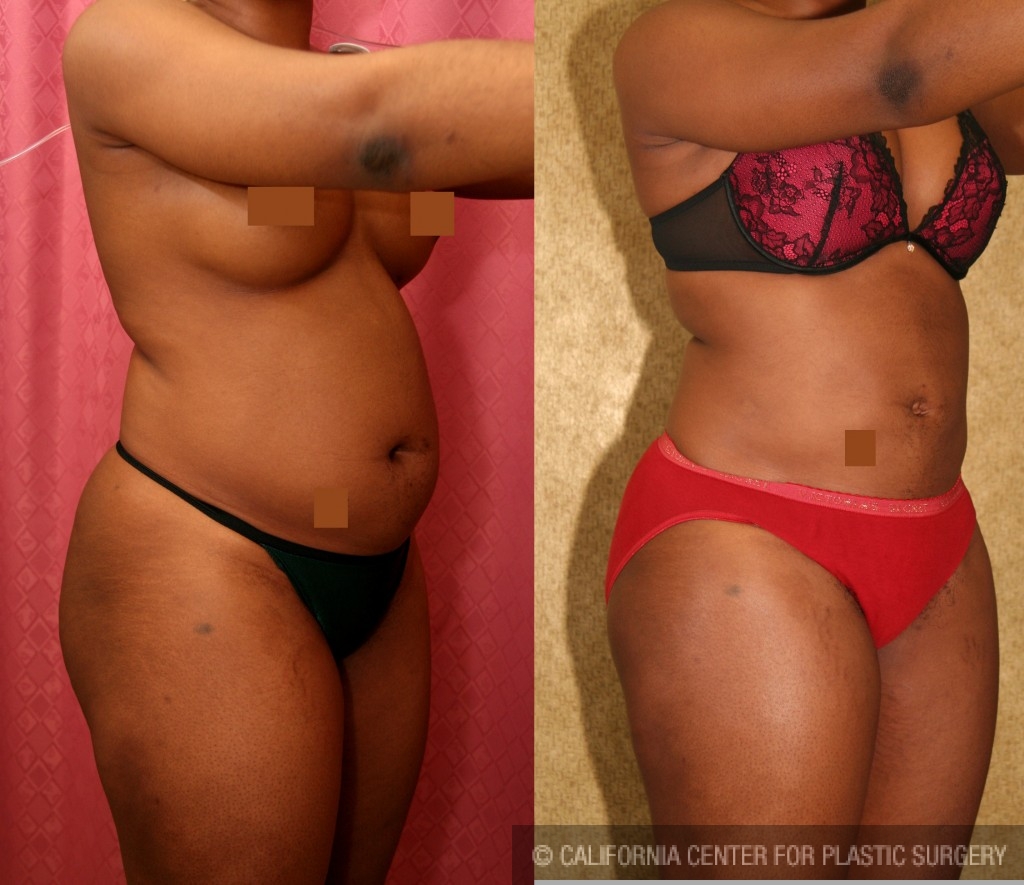 3,935 Liposuction Black Woman Images, Stock Photos, 3D objects, & Vectors