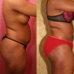 Liposuction Abdomen Medium Before & After Patient #5557