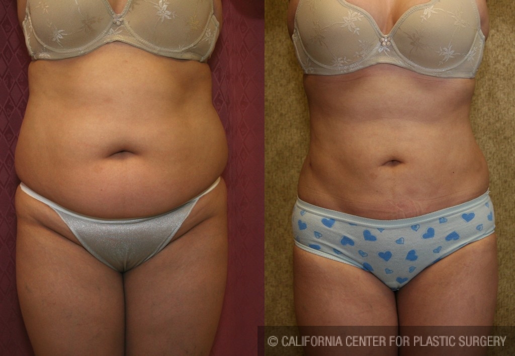 Liposuction Abdomen Plus Size Before & After Patient #5589