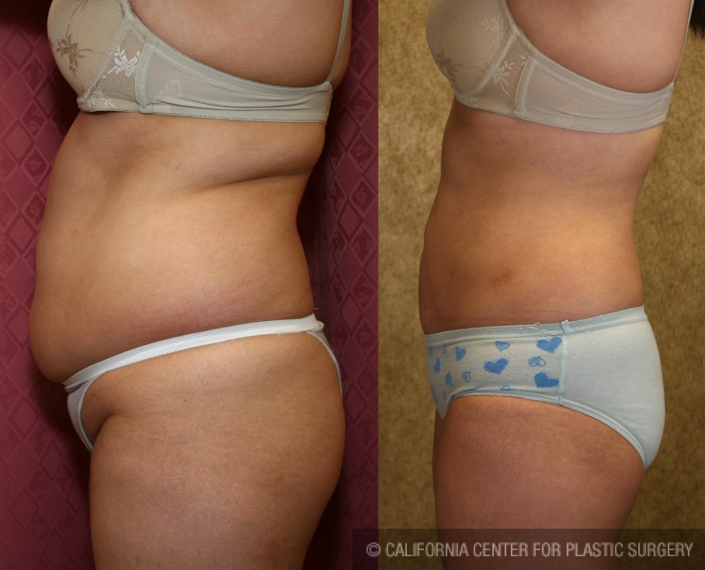 Liposuction Abdomen Plus Size Before & After Patient #5589