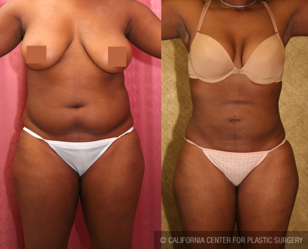 Smartlipo Flanks Liposuction for Women - Before & After Photos