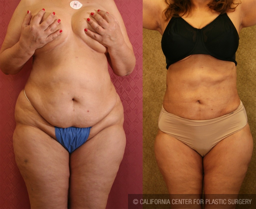 Patient #5593 Liposuction Abdomen Plus Size Before and After
