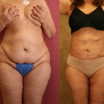 Liposuction Abdomen Plus Size Before & After Patient #5593